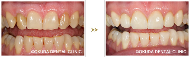 オールセラミックのビフォーアフター