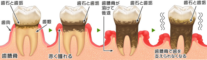 歯周病の進行